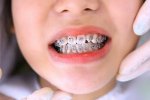 10 điều khuyến cáo khi niềng răng