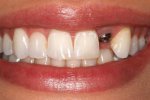 Chăm sóc răng cấy ghép Implant như thế nào?