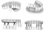 Lợi ích và rủi ro khi trồng răng Implant